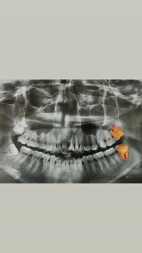 Реставрация зубов