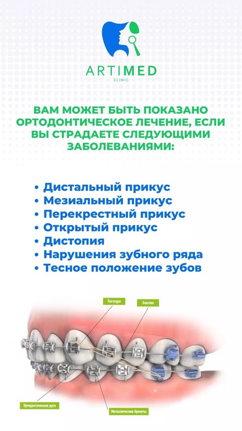 Ортодонтия — брекет-системы