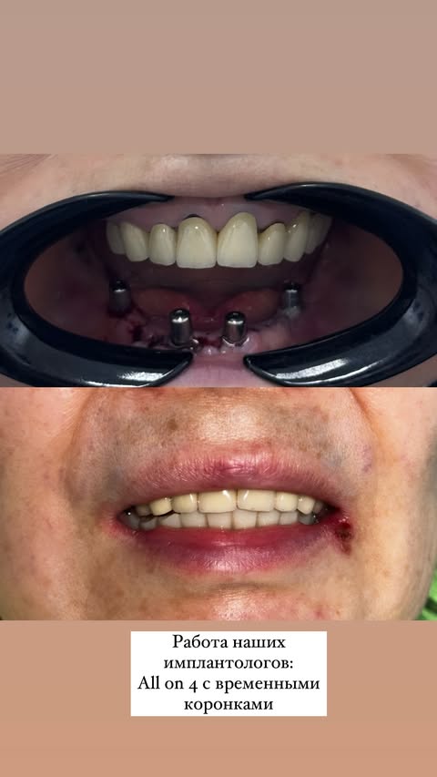 All on 4 — результат 1