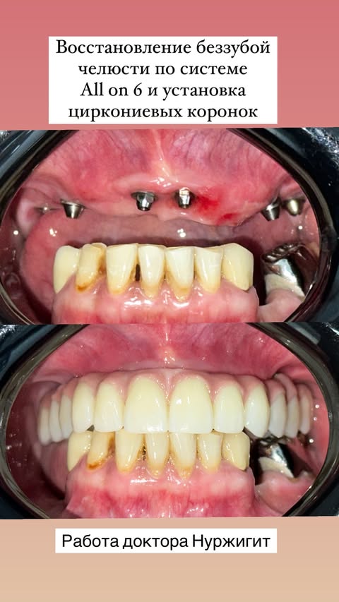 Результат имплантации All on 4 в клинике ARTIMED