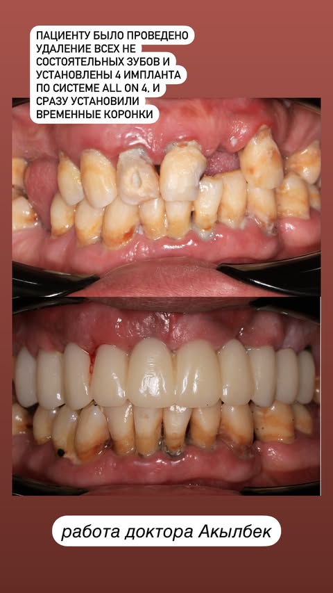До и после имплантации